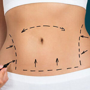 abdominoplasty