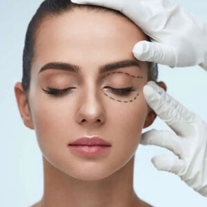 blepharoplasty