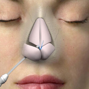 rhinoplasty