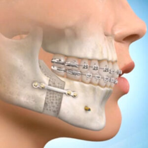 jaw surgery