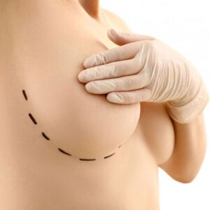 mammoplasty and lift